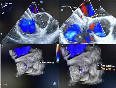 Case Report: Persistent residual shunt after a first percutaneous PFO closure followed by minimally invasive surgical failure: third time is a charm